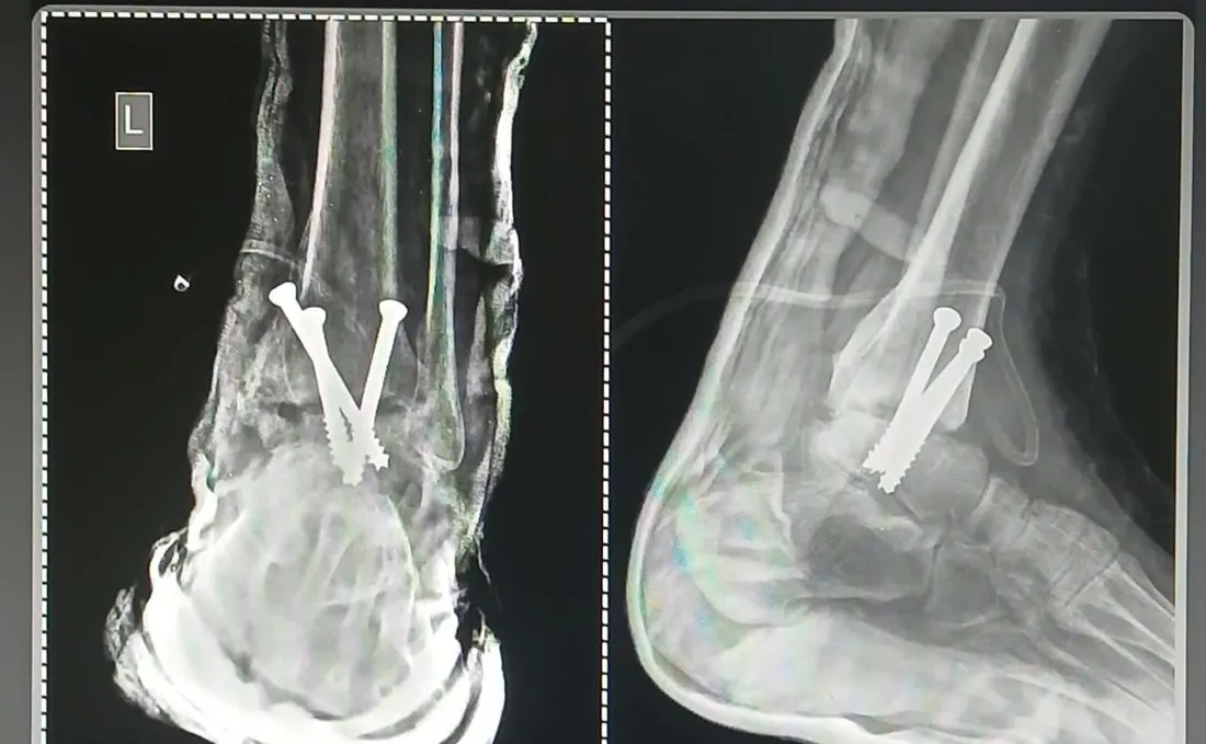 X-ray after ankle arthrodesis (ankle fusion) with cannulated screws