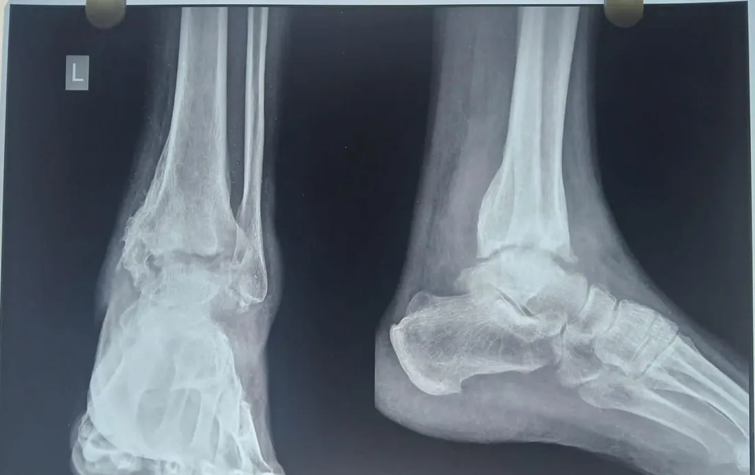 X-ray of post-traumatic ankle arthritis before ankle arthrodesis