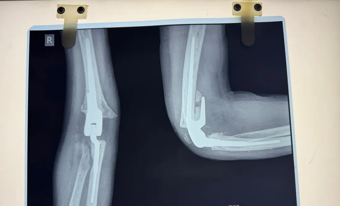 X-ray of a total elbow replacement following TB of the elbow