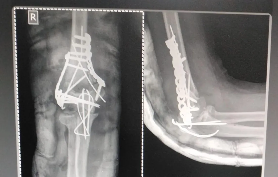 Elbow X-ray