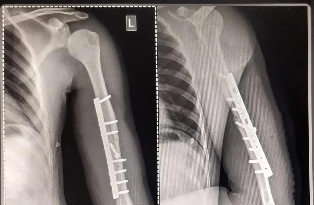 Plate Fixation