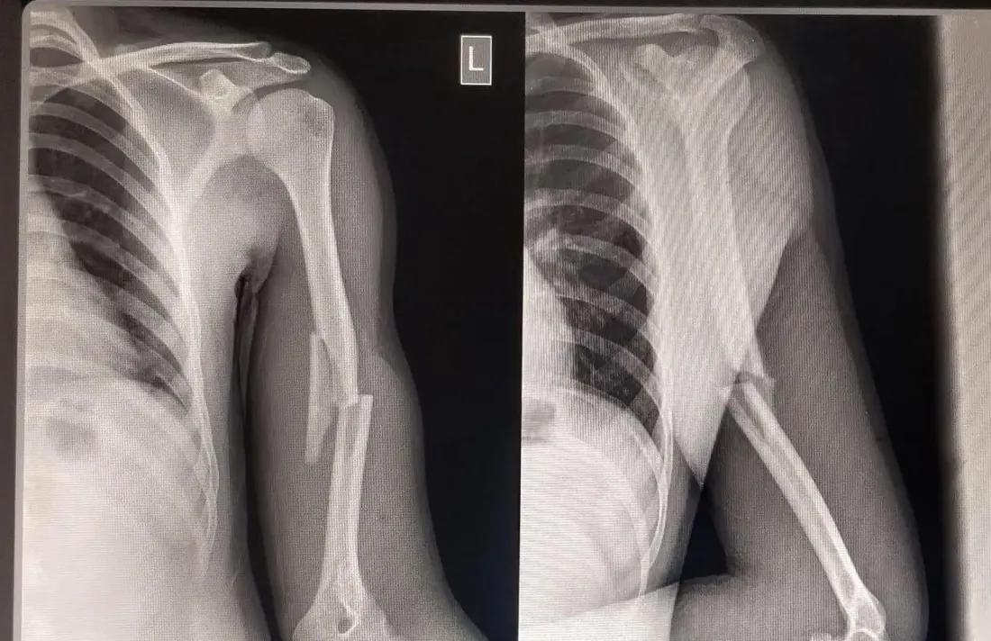 Humerus Shaft Fracture