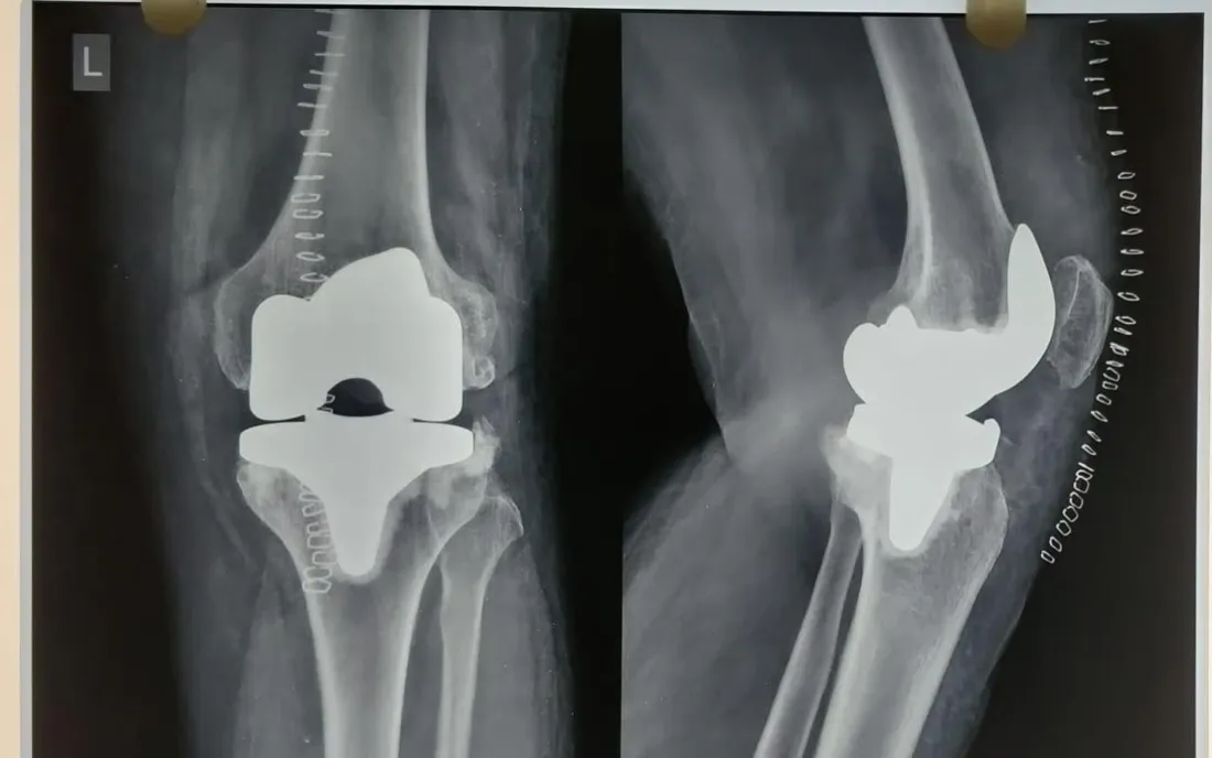 Total Knee Replacement, Left