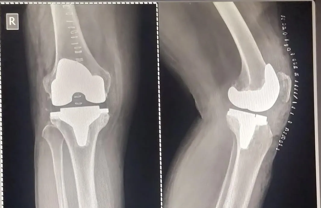 Total Knee Replacement, Right