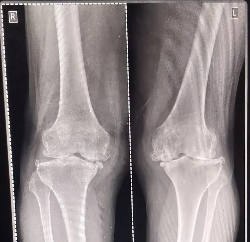 Both Knees, Severe Arthritis
