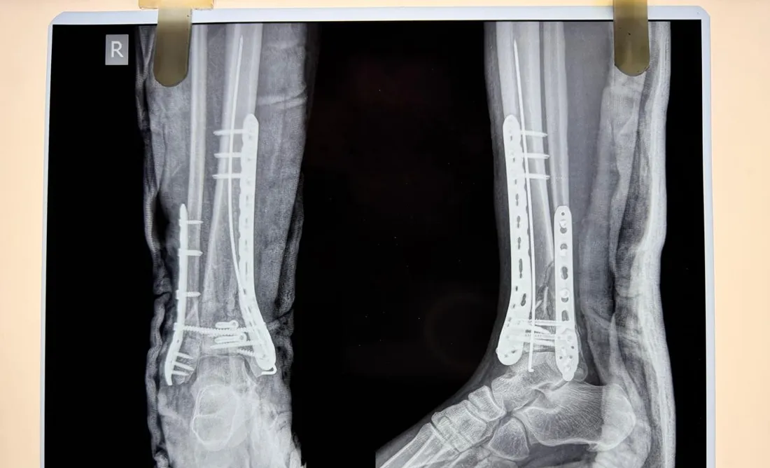 Plate Fixation