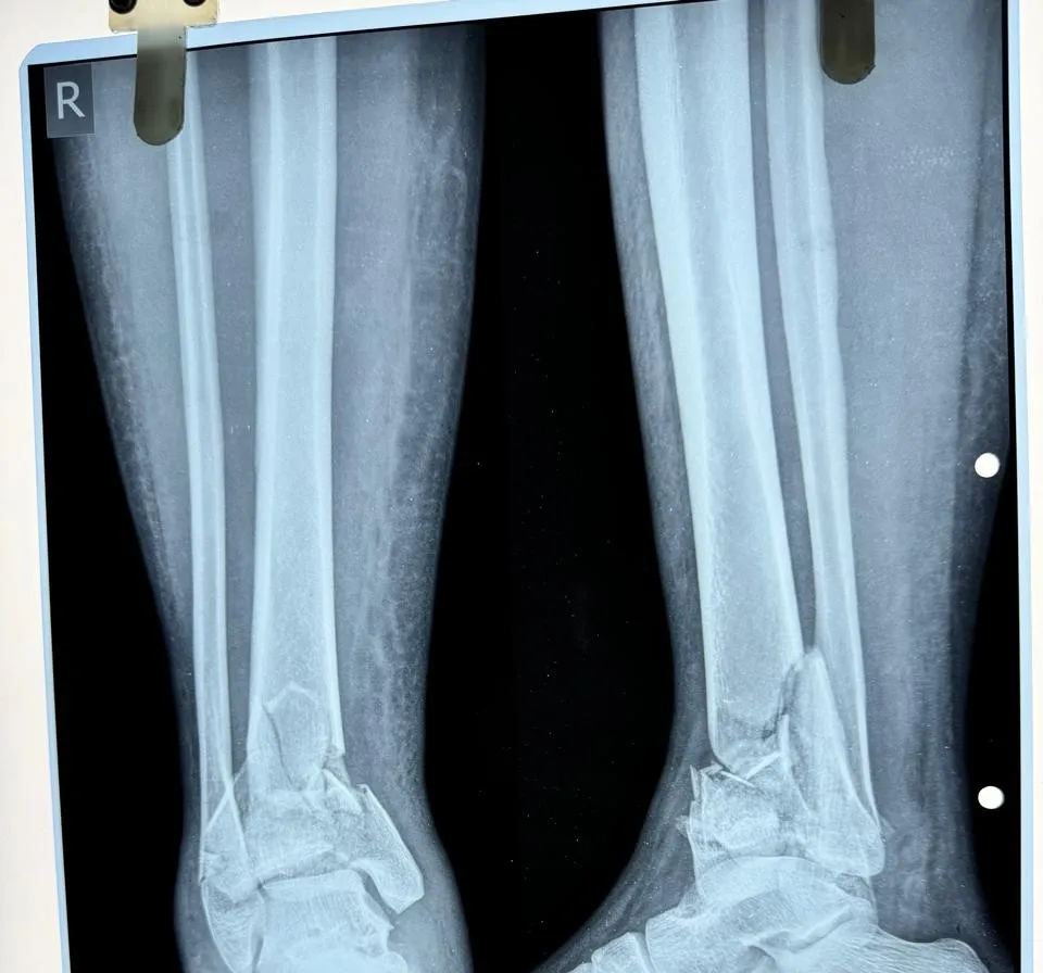 Distal Tibia Fracture