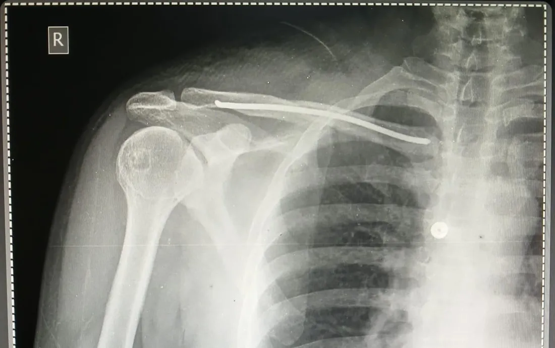 X-ray of the clavicle fracture after reduction and pin fixation