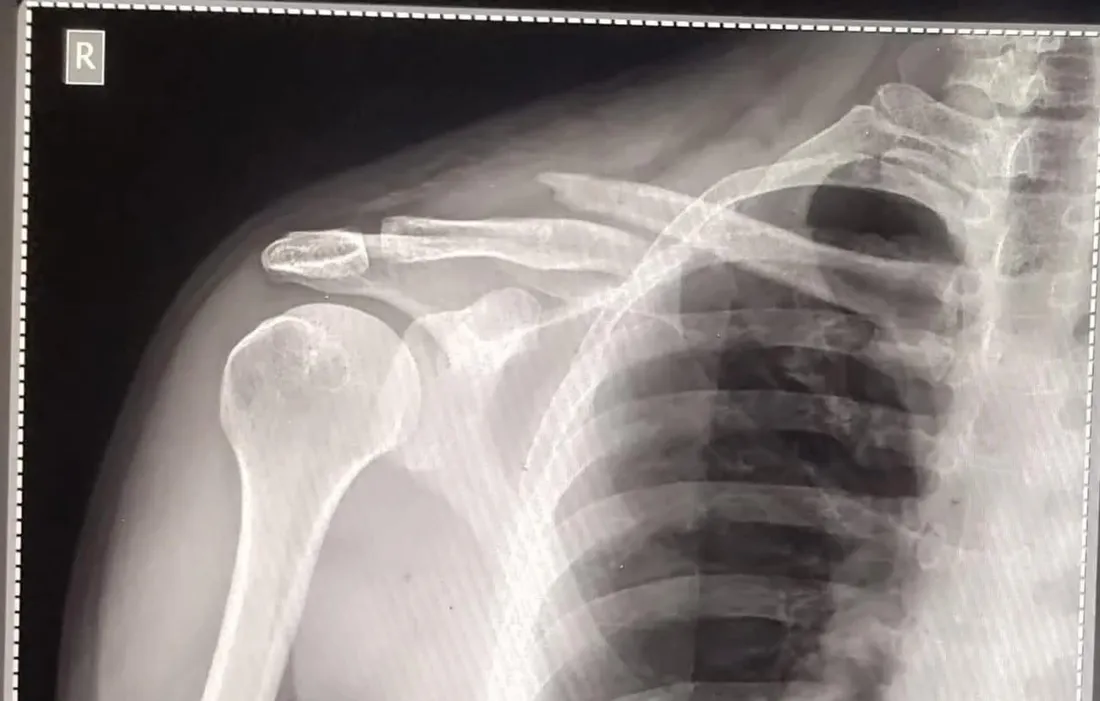 X-ray of a clavicle (collarbone) fracture before treatment