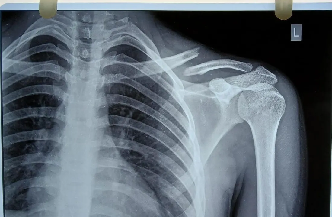 Shoulder X-ray