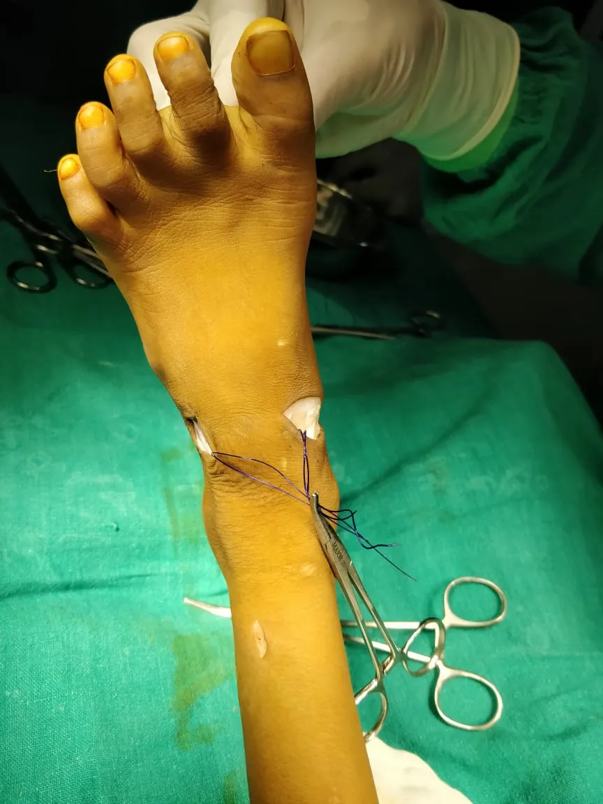 Surgical photo of a foot operation