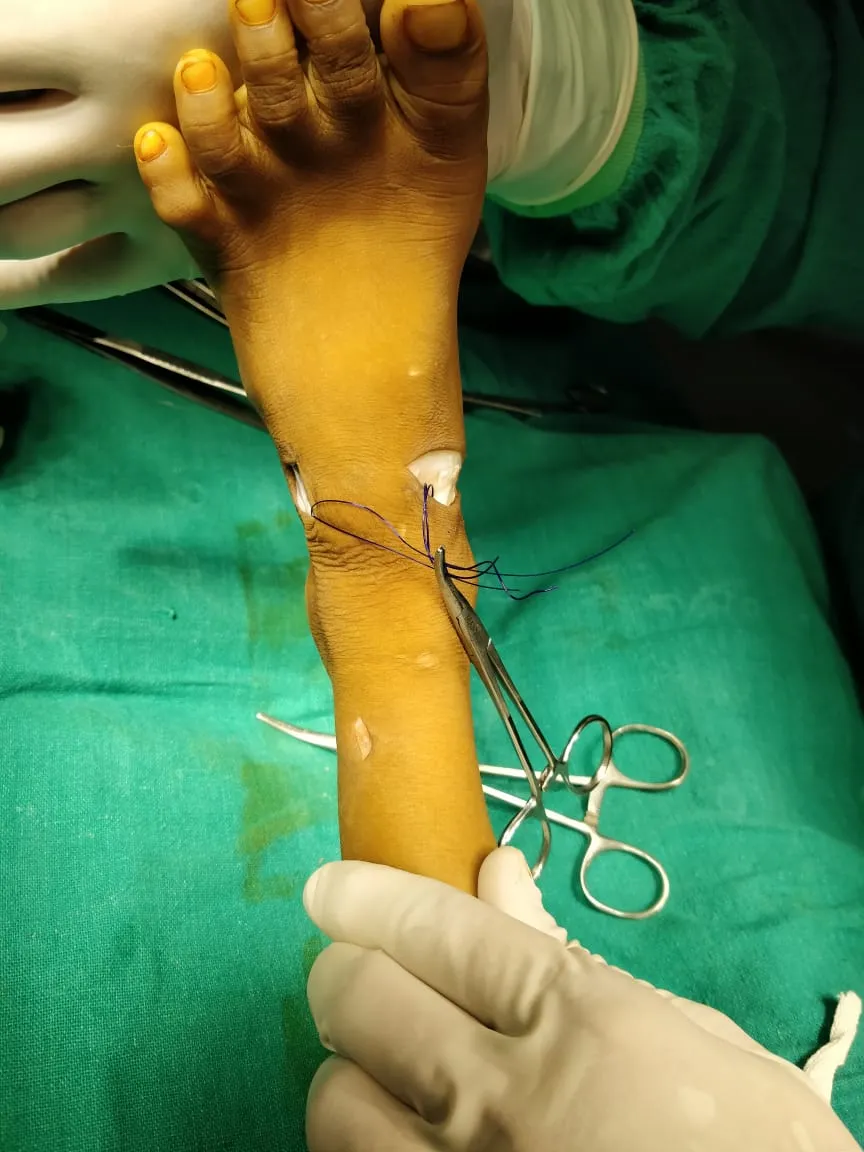 Surgical photo of a foot operation