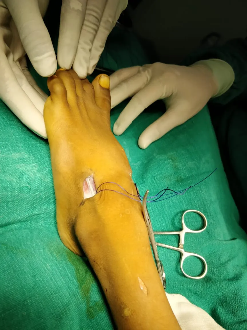 Surgical photo of a foot operation